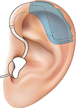 Цифровые слуховые аппараты